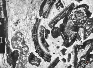 M,66y. | follicular cyst with hyaline Rushton bodies M,66y. | follicular cyst with hyaline Rushton bodies